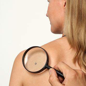 image service laser-skin-tags-removal