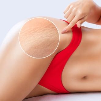treatments stretch-marks-on-the-skin