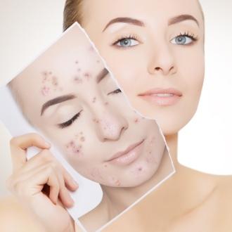treatments acne-scars